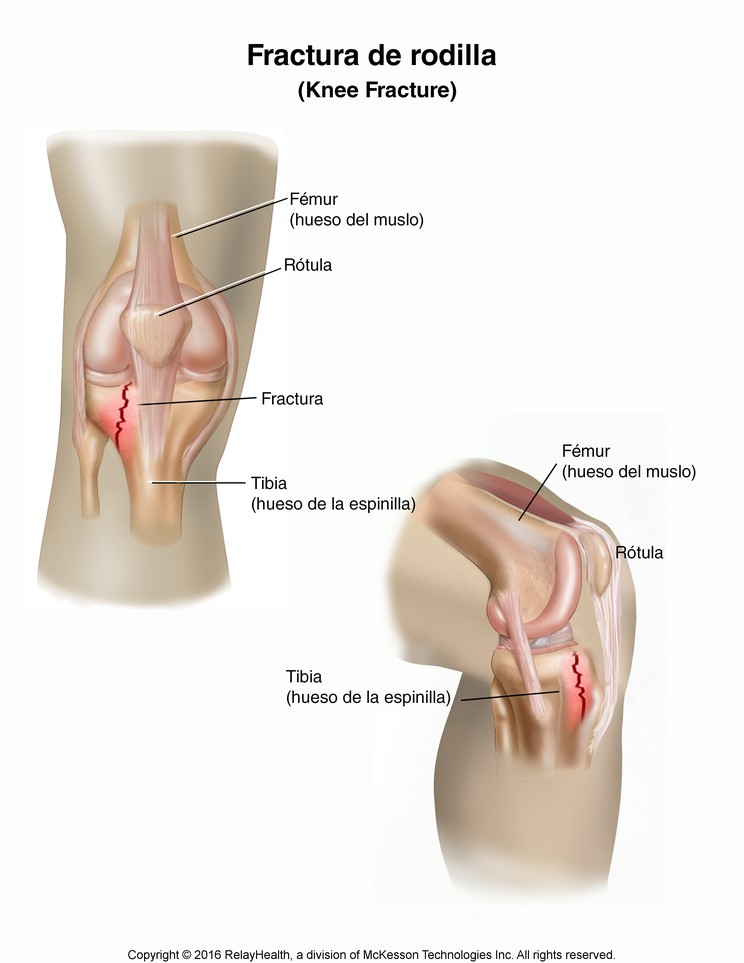 Knee Fracture: Illustration