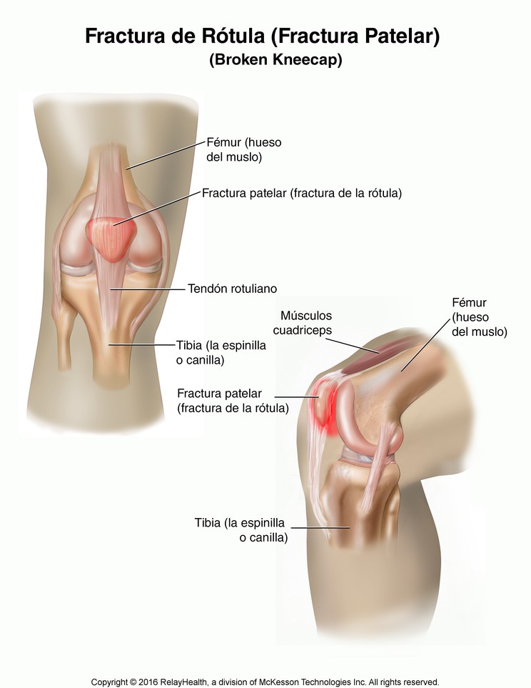 Kneecap (Patellar) Fracture: Illustration