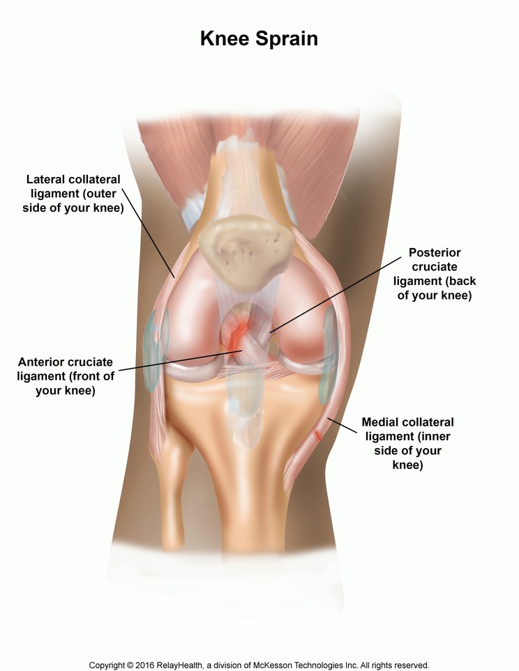 Knee Sprain: Illustration