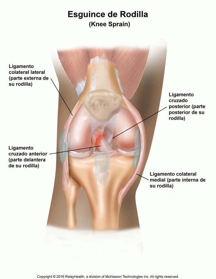 Knee Sprain: Illustration