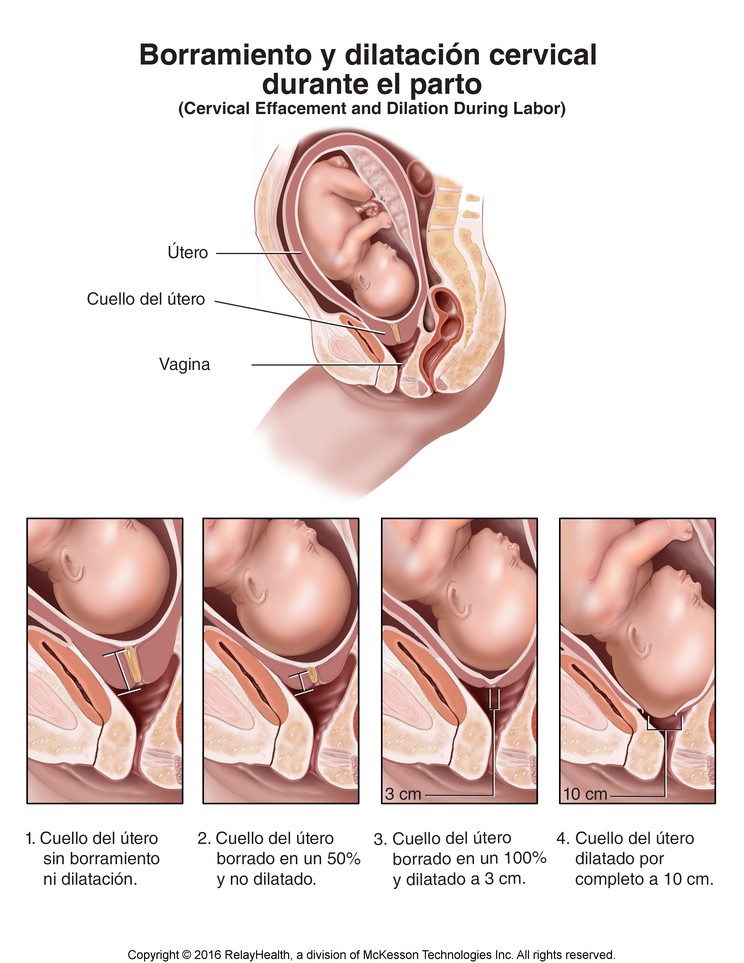 Cervical Effacement and Dilation During Labor: Illustration