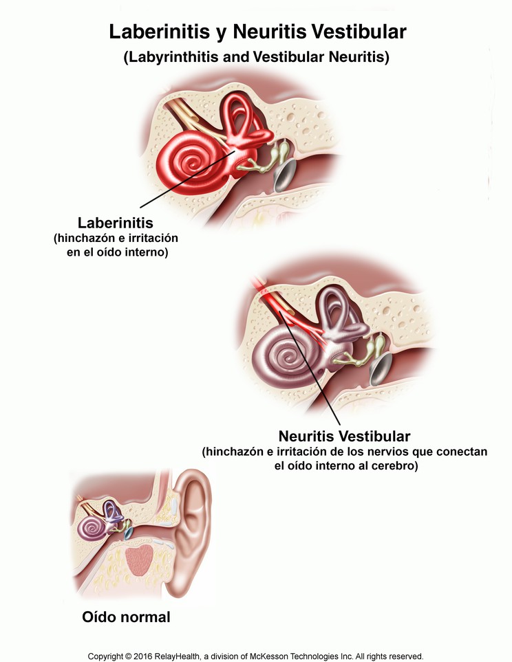 Labyrinthitis and Vestibular Neuritis: Illustration