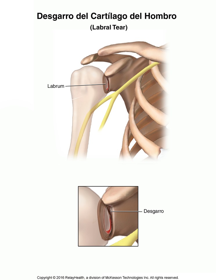 Shoulder Cartilage Tear (Labral Tear): Illustration