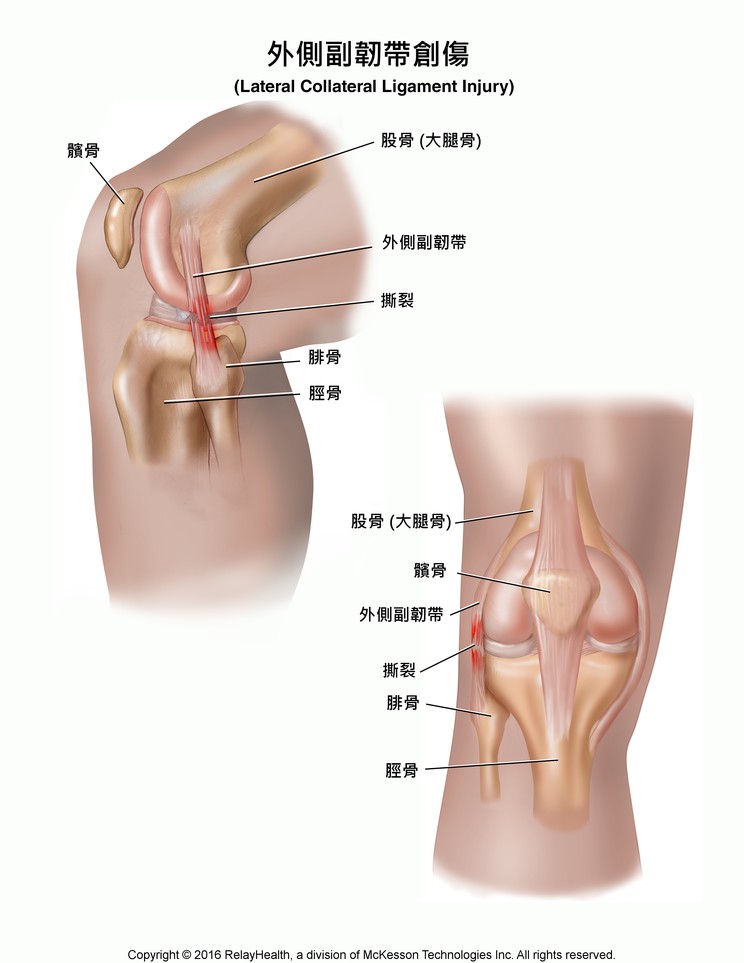 Lateral Collateral Ligament Injury: Illustration