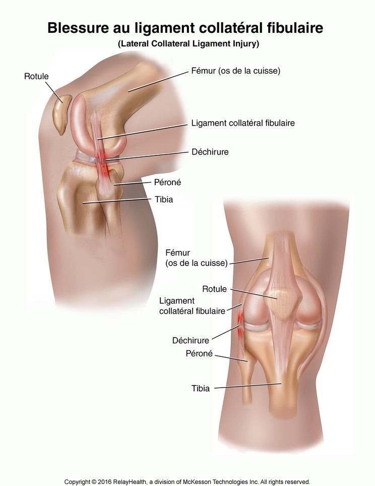 Lateral Collateral Ligament Injury: Illustration