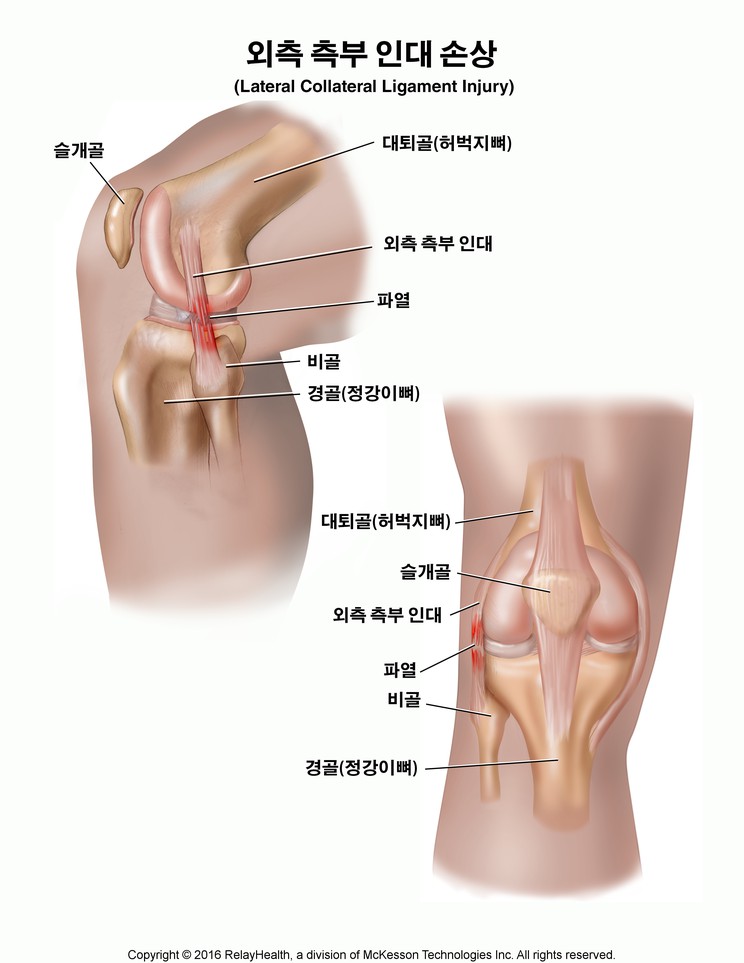 Lateral Collateral Ligament Injury: Illustration
