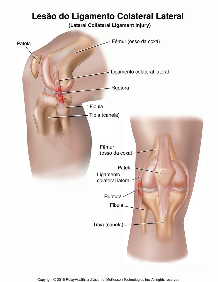Lateral Collateral Ligament Injury: Illustration