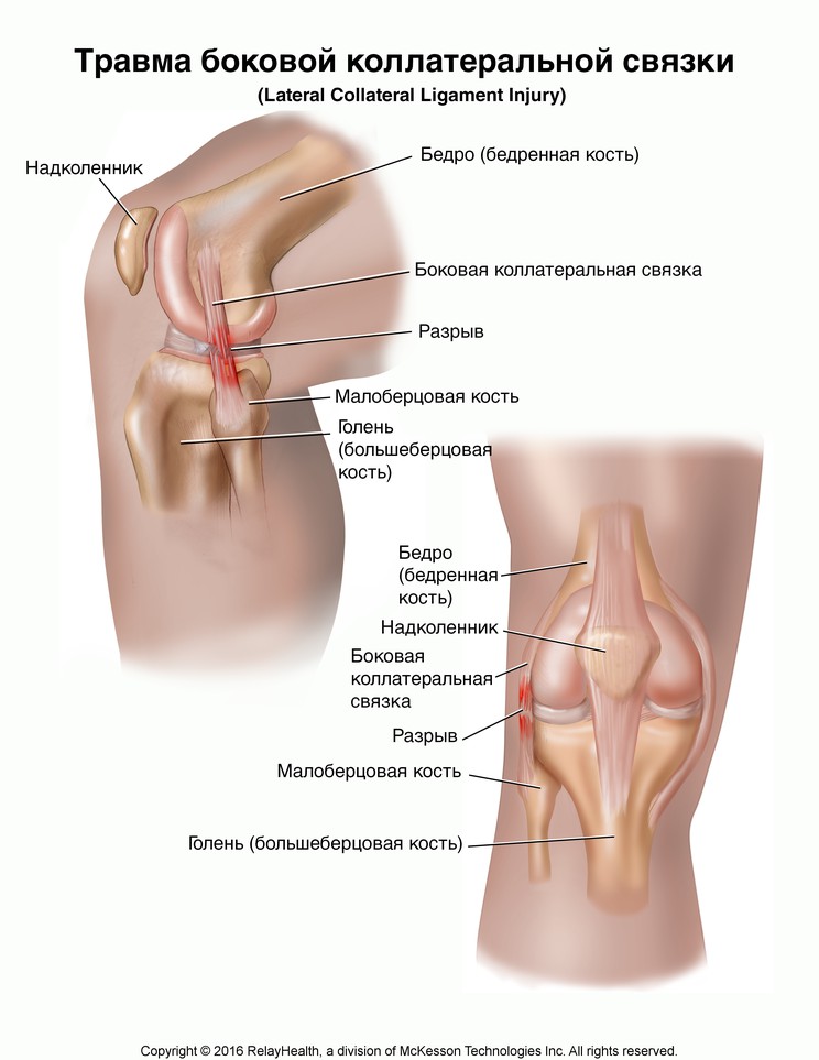 Lateral Collateral Ligament Injury: Illustration