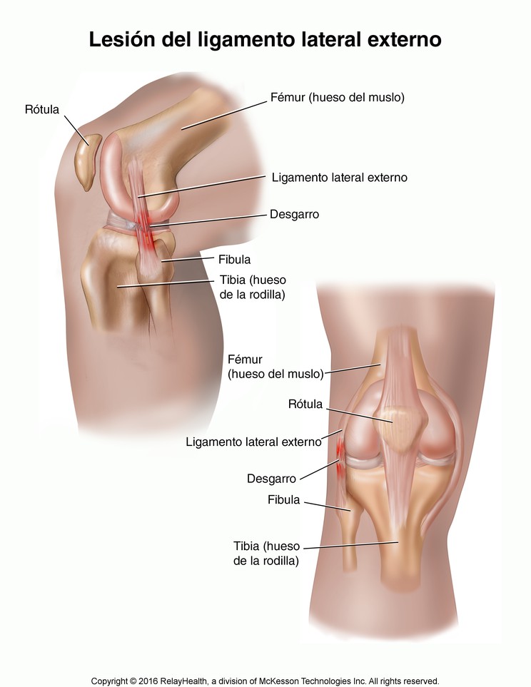 Lateral Collateral Ligament Injury: Illustration