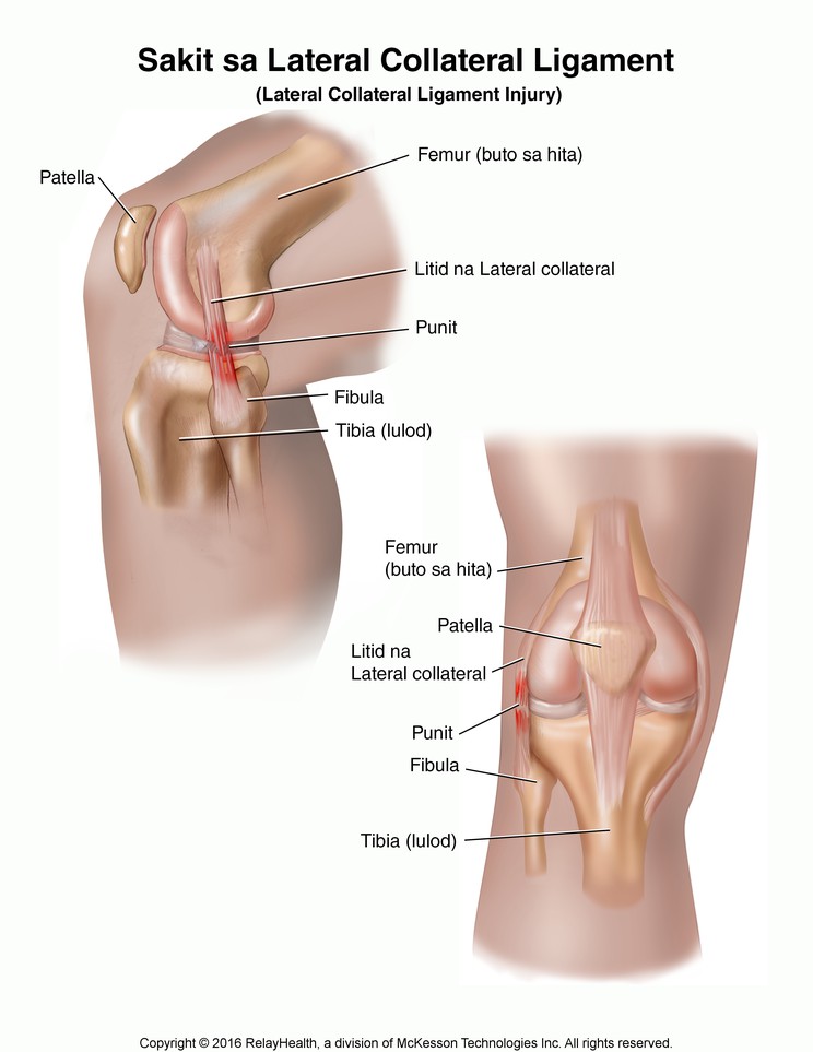 Lateral Collateral Ligament Injury: Illustration