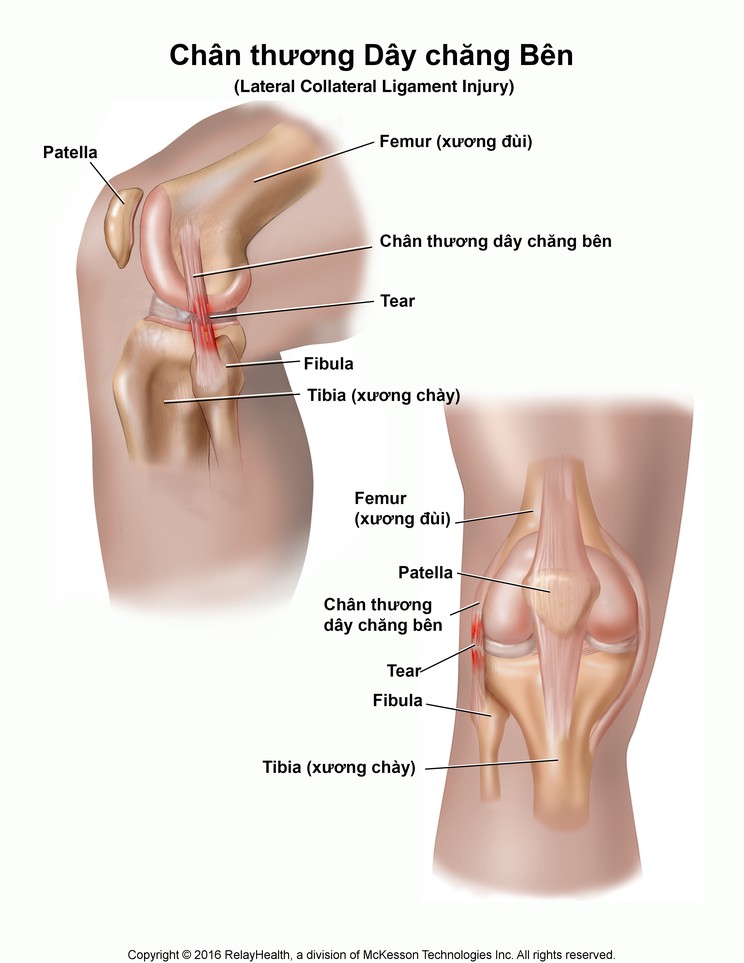 Lateral Collateral Ligament Injury: Illustration