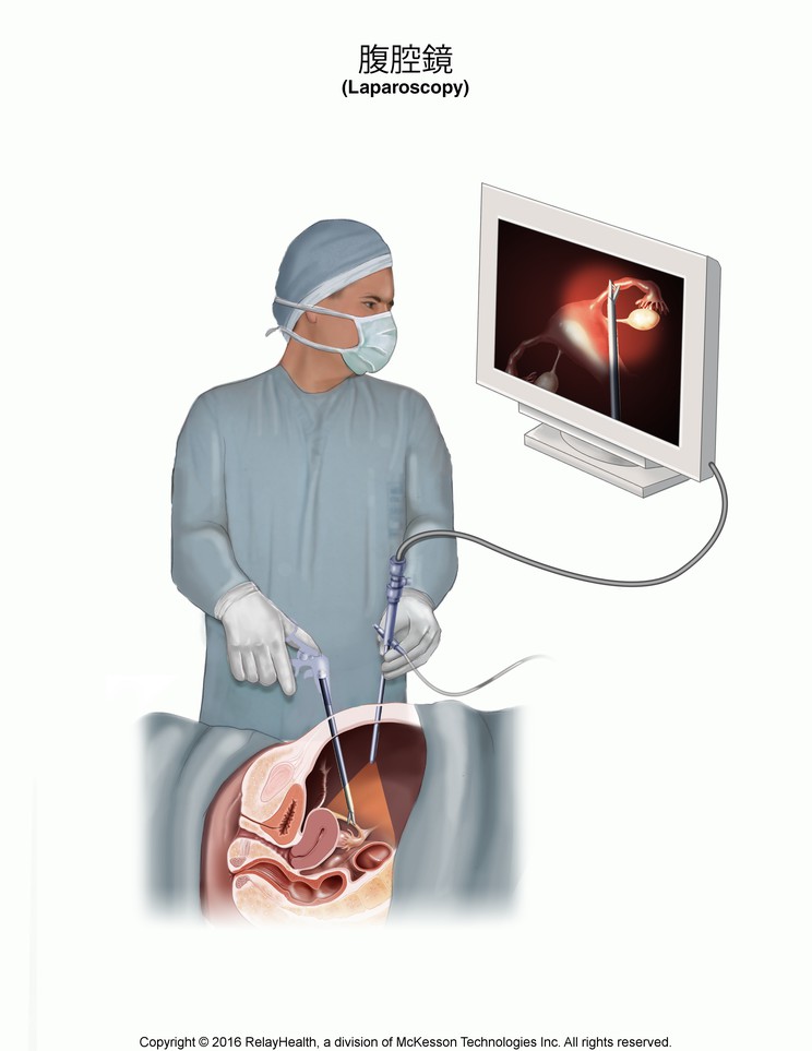 Laparoscopy: Illustration