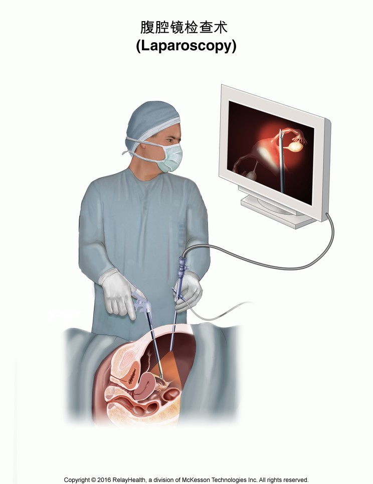 Laparoscopy: Illustration