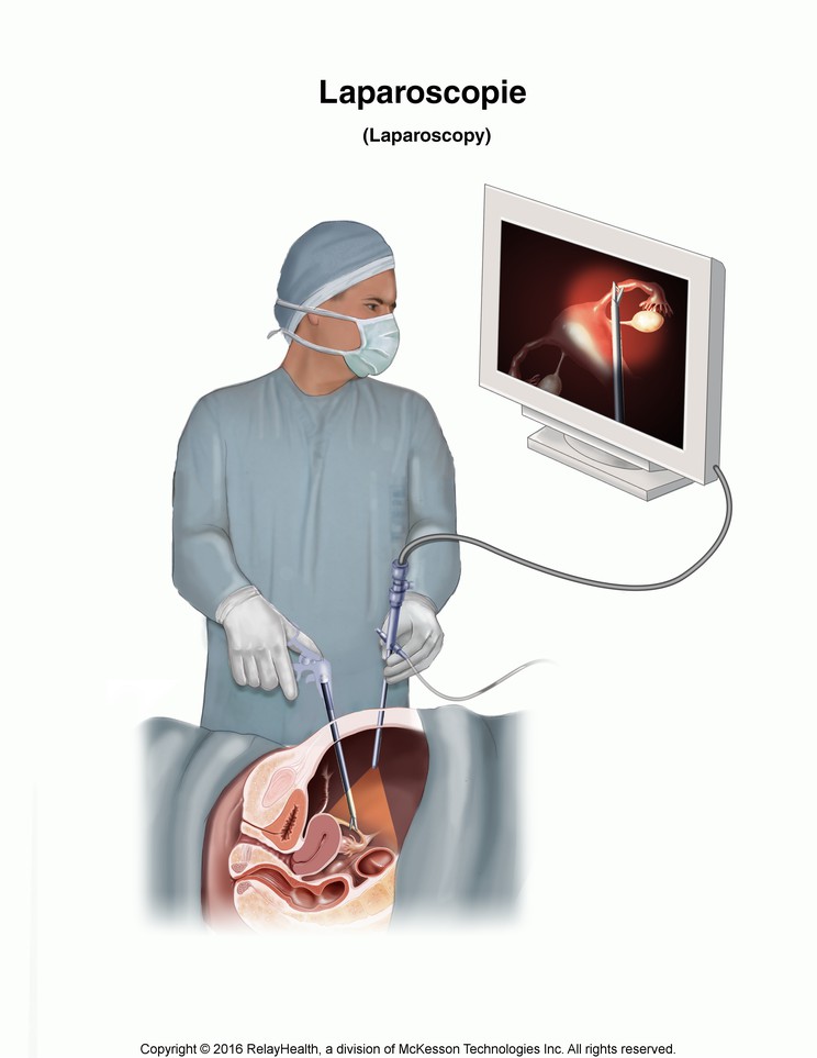 Laparoscopy: Illustration