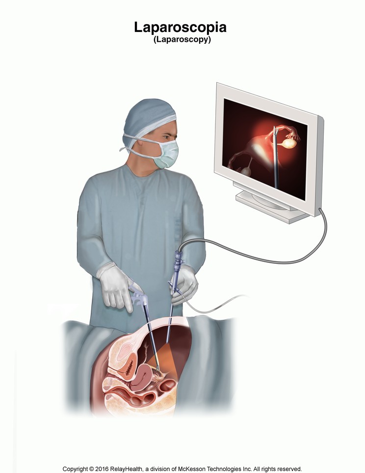 Laparoscopy: Illustration