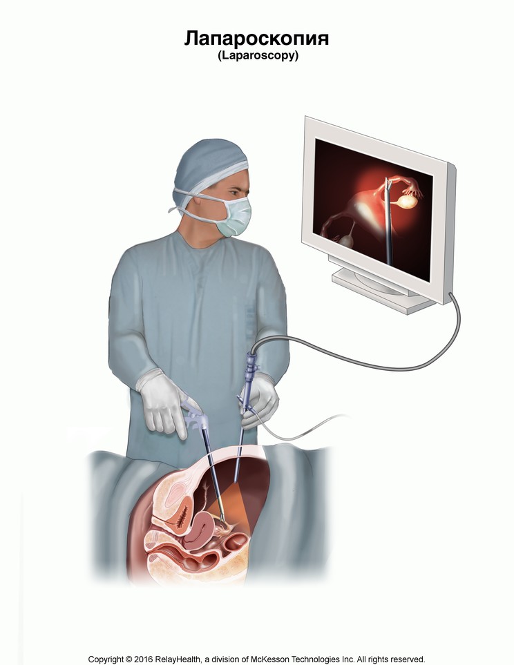 Laparoscopy: Illustration