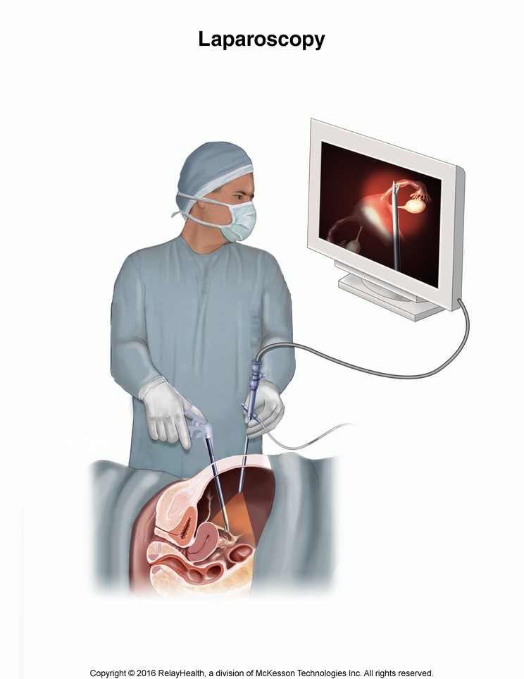 Laparoscopy: Illustration