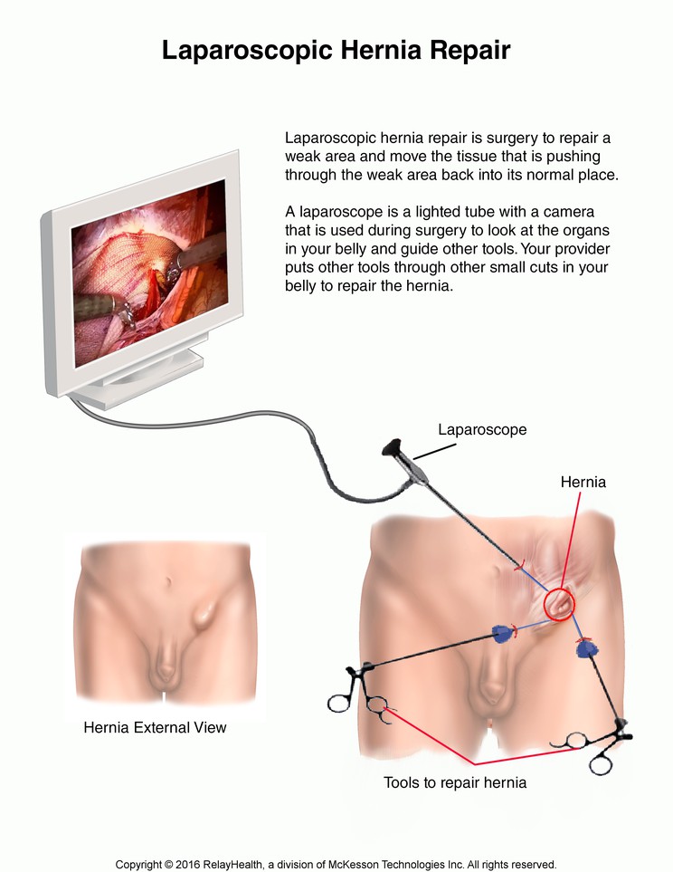 Laparoscopic Hernia Repair: Illustration