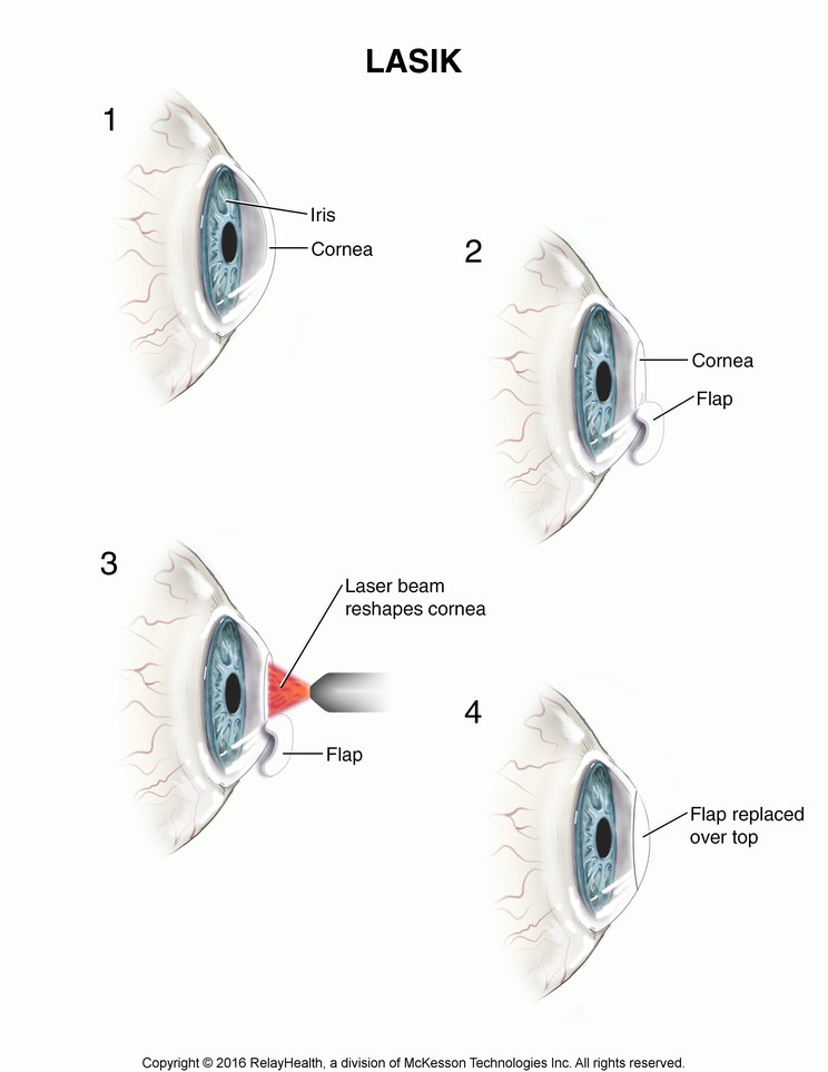 LASIK: Illustration