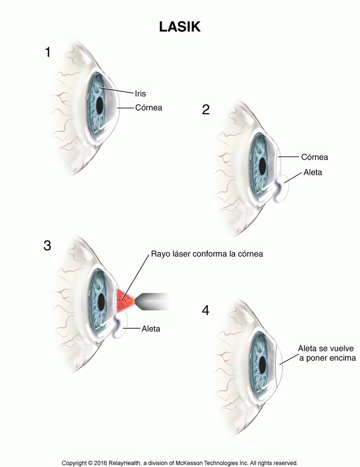 LASIK: Illustration