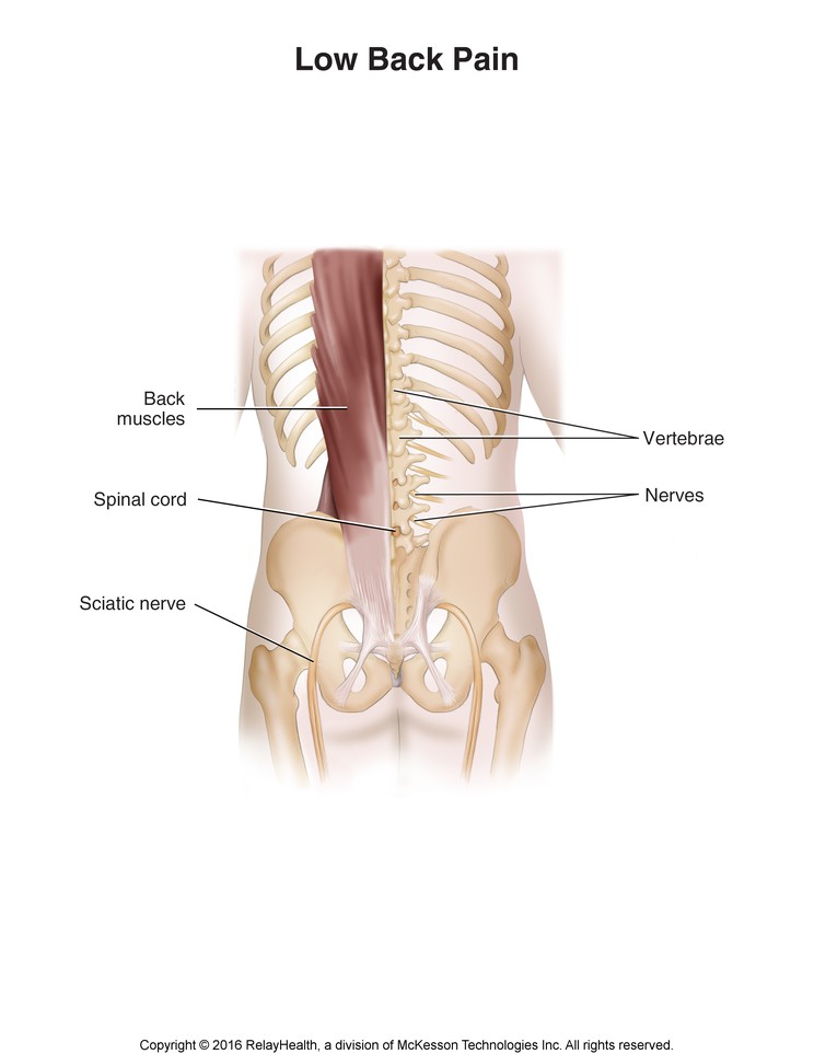 Low Back Pain: Illustration