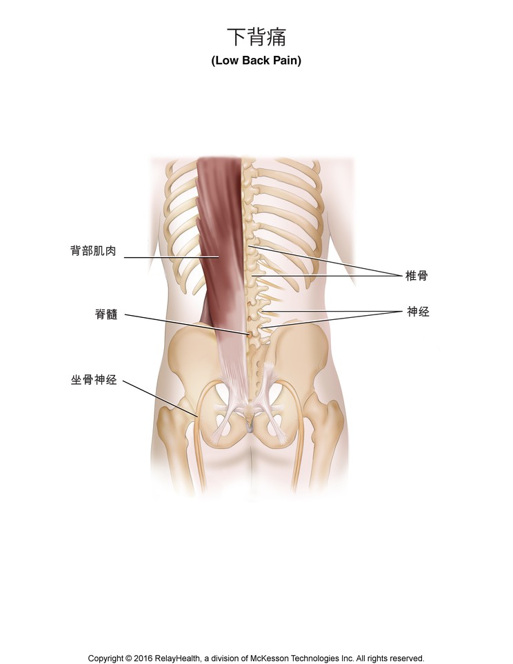 Low Back Pain: Illustration