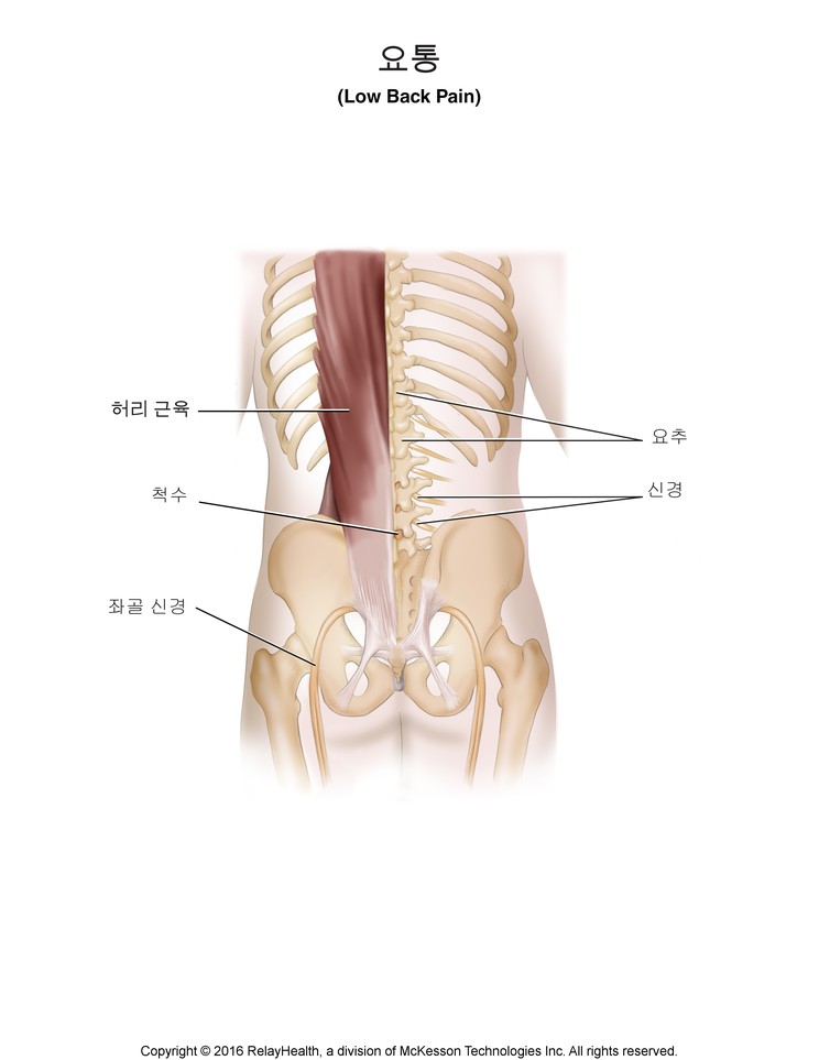 Low Back Pain: Illustration
