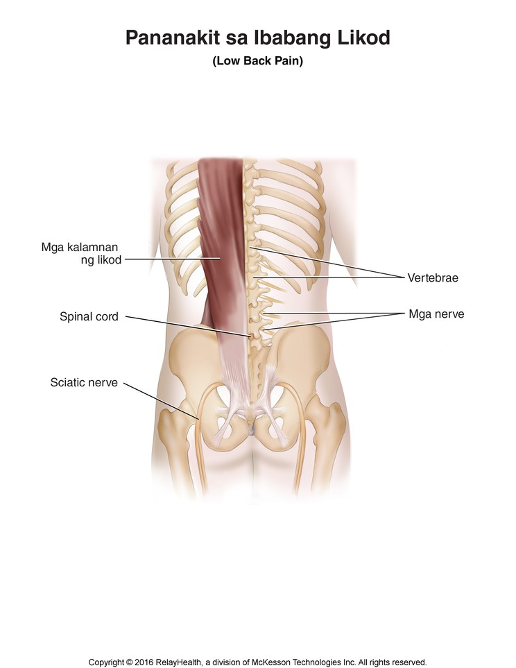 Low Back Pain: Illustration