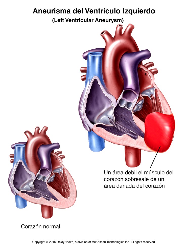 Left Ventricular Aneurysm: Illustration