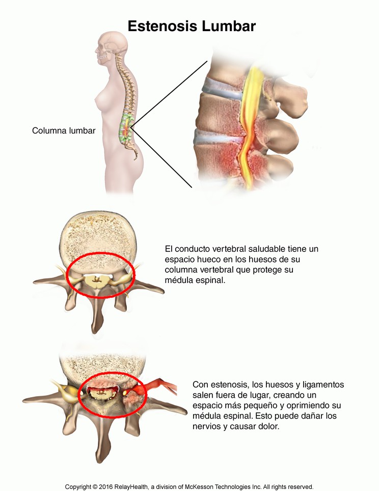 Lumbar Stenosis: Illustration