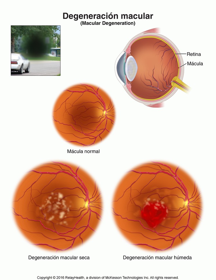 Macular Degeneration: Illustration