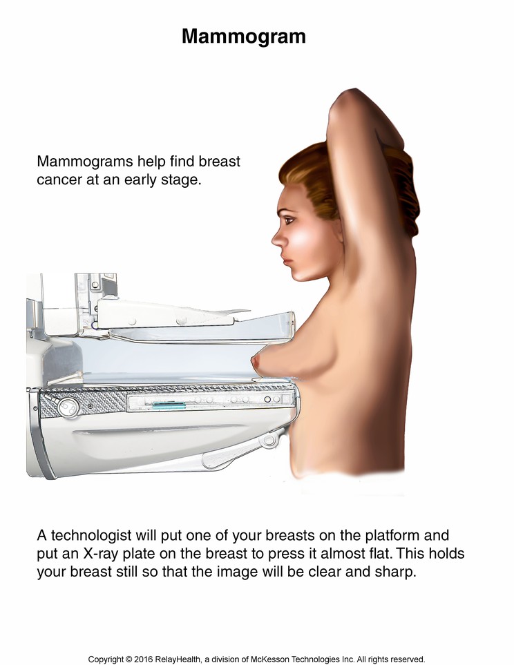 Mammogram: Illustration