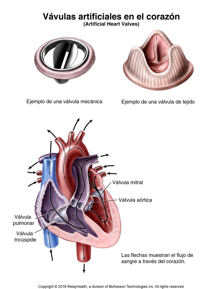 Heart Valves, Artificial: Illustration