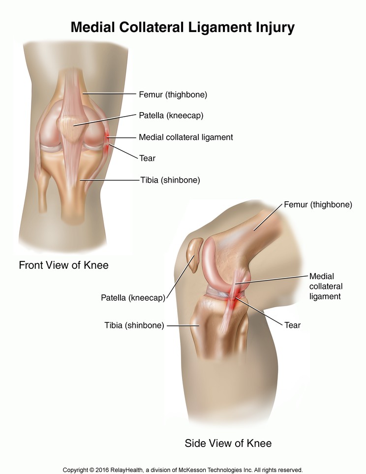 Medial Collateral Ligament Injury: Illustration