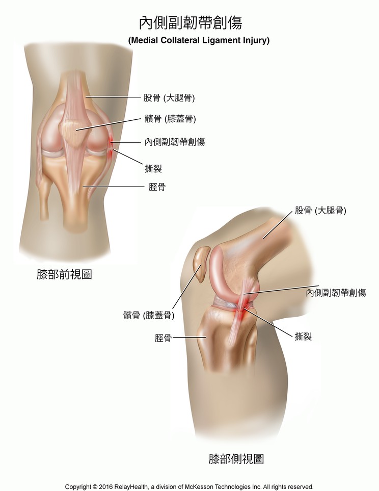 Medial Collateral Ligament Tear: Illustration