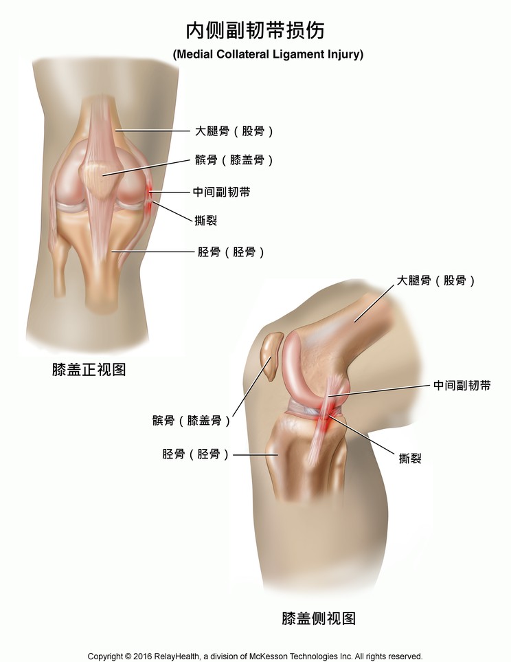 Medial Collateral Ligament Tear: Illustration