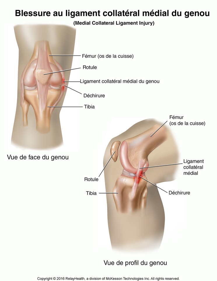 Medial Collateral Ligament Tear: Illustration
