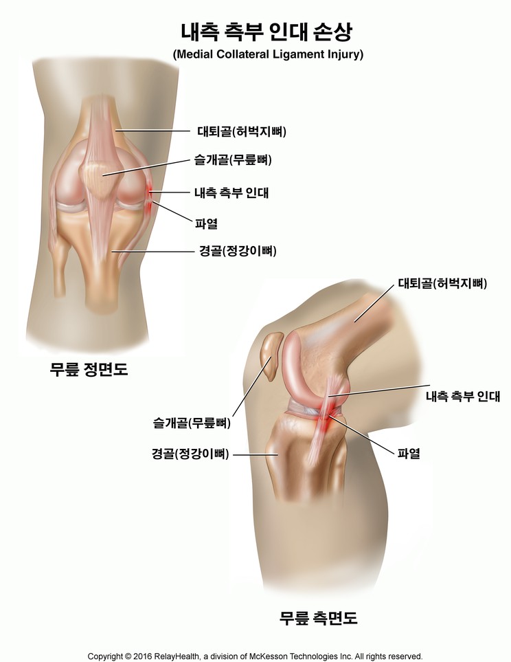Medial Collateral Ligament Tear: Illustration