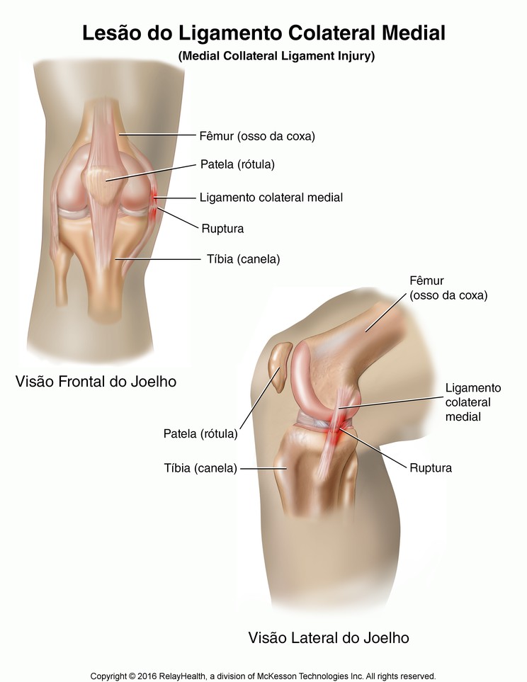 Medial Collateral Ligament Tear: Illustration