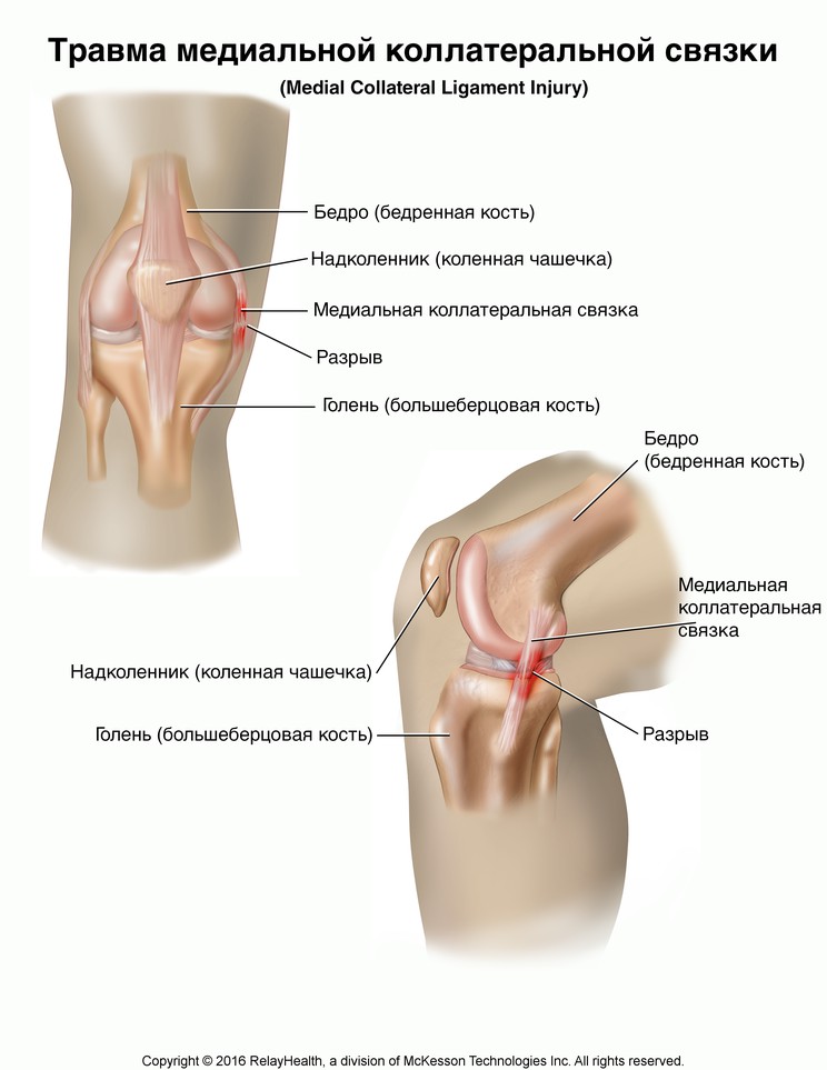 Medial Collateral Ligament Tear: Illustration