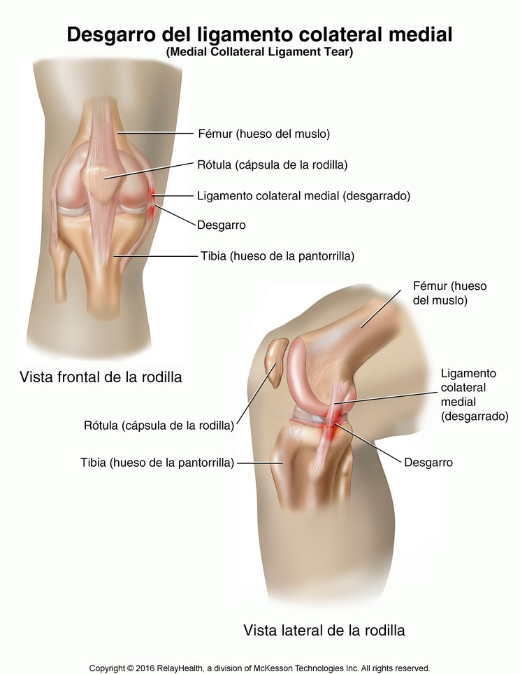 Medial Collateral Ligament Tear: Illustration