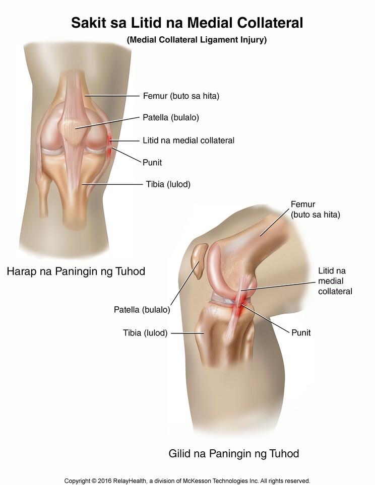 Medial Collateral Ligament Tear: Illustration