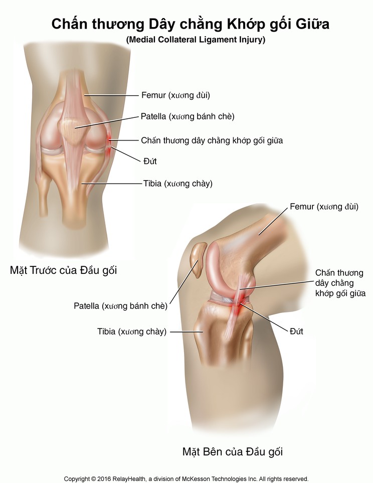 Medial Collateral Ligament Tear: Illustration