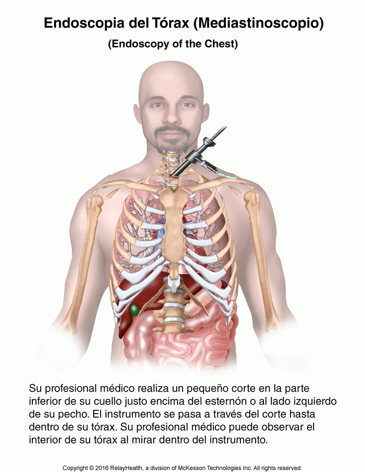 Endoscopy of the Chest: Illustration