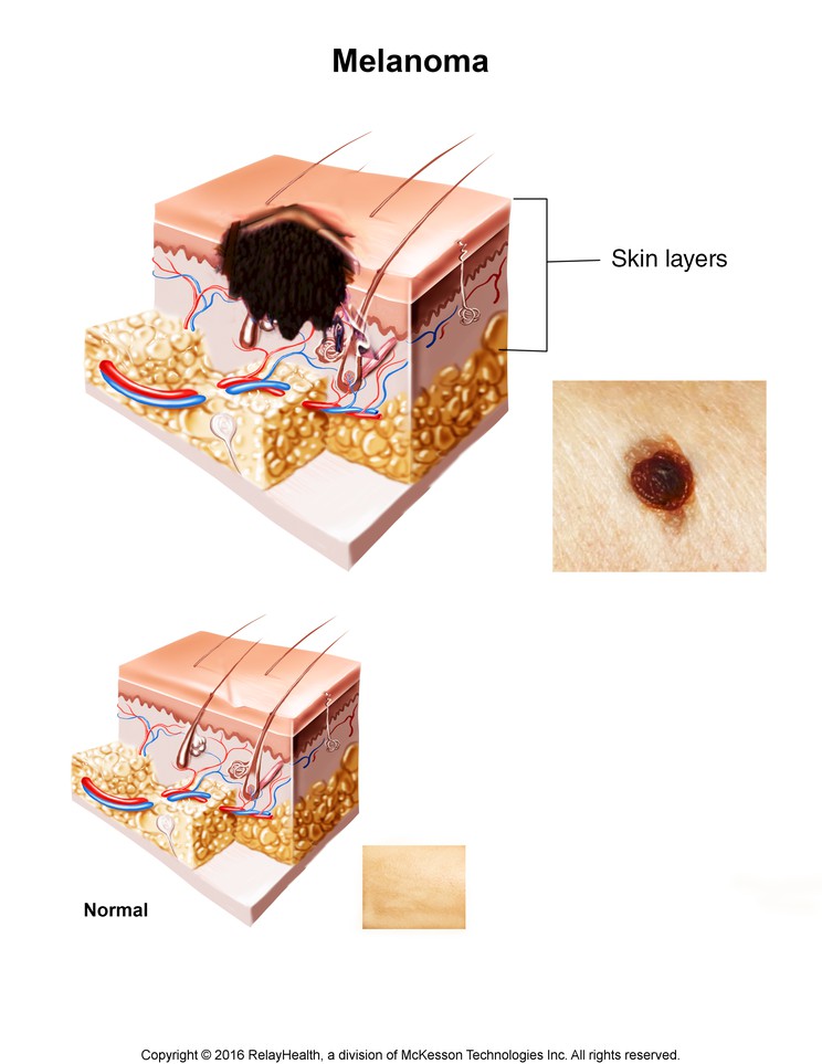Melanoma: Illustration