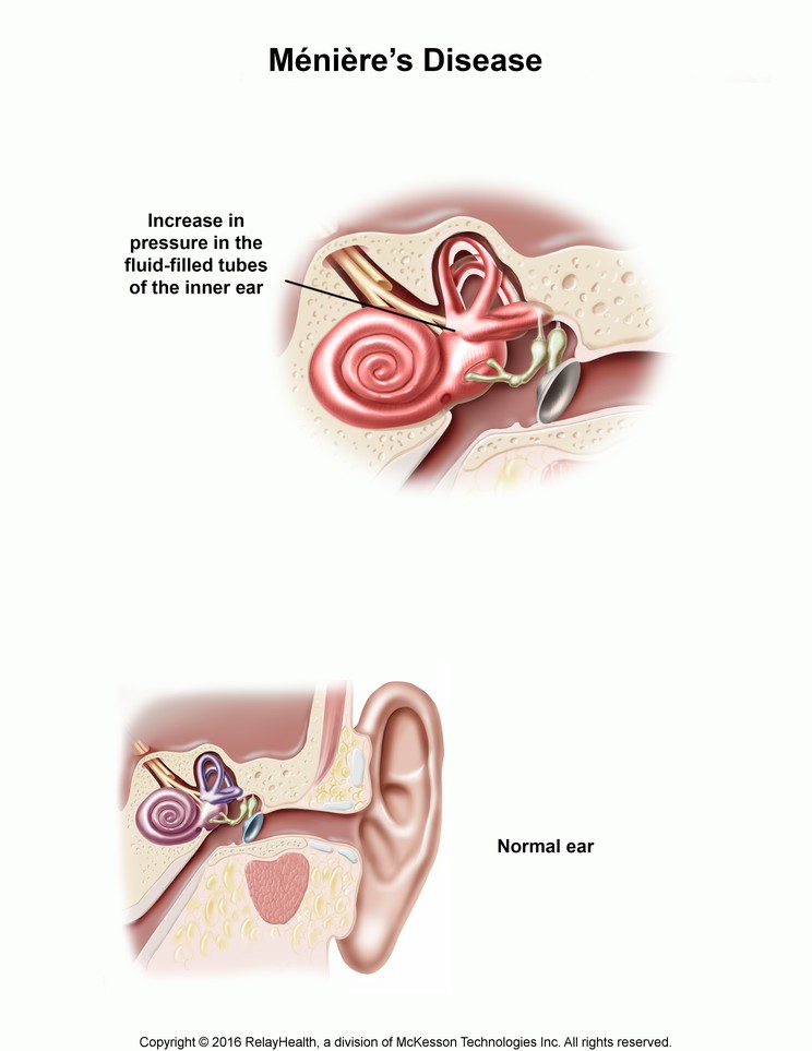 Ménière’s Disease: Illustration