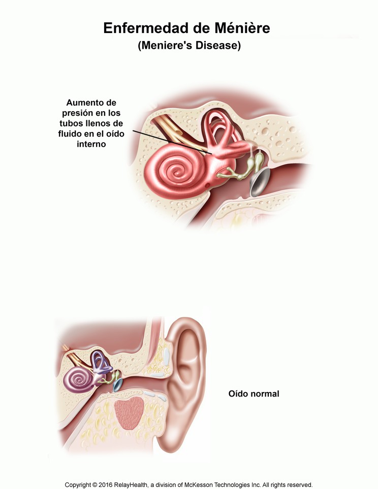 Ménière’s Disease: Illustration
