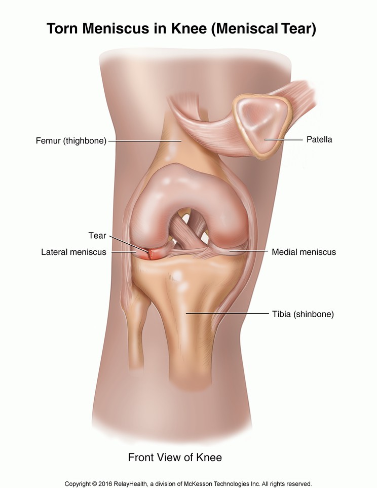 Torn Meniscus in Knee (Meniscal Tear): Illustration