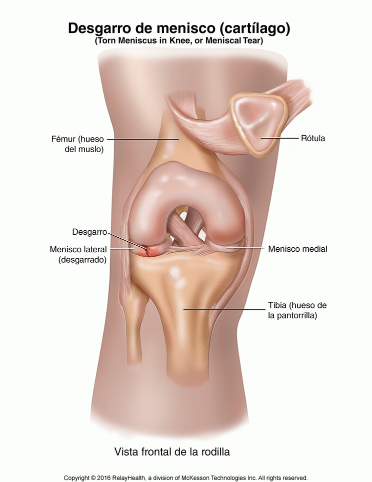 Meniscal (Cartilage) Tear: Illustration