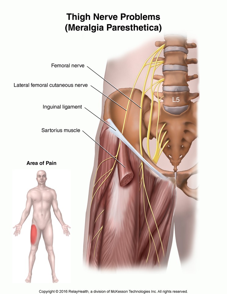 Thigh Nerve Problems (Meralgia Paresthetica): Illustration